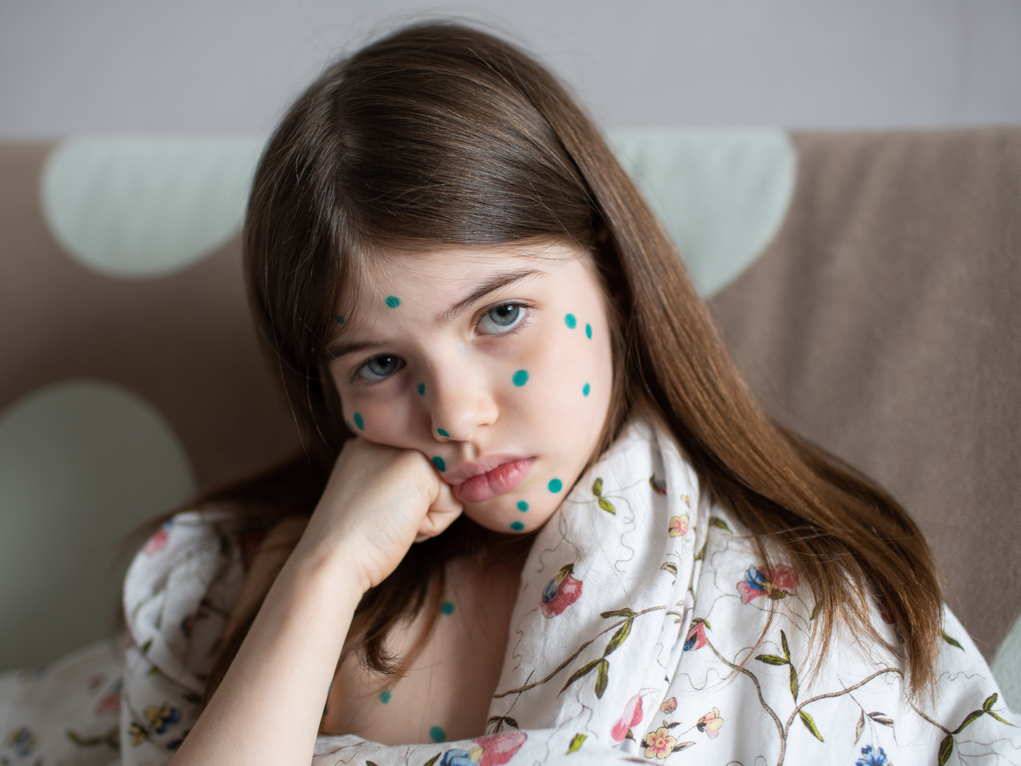 A Brief History of Chickenpox