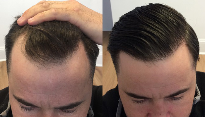 London’s Hair Transplant Innovators: Defying Hair Loss Together