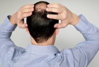 3 Insights for Men Struggling with Male Pattern Baldness