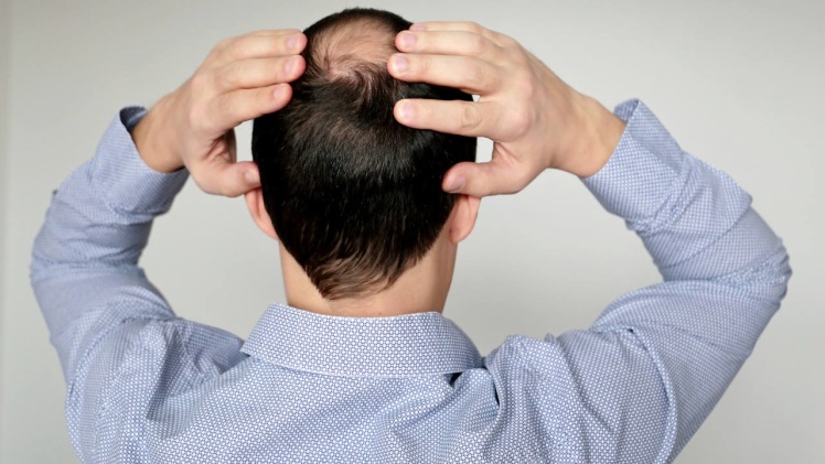 3 Insights for Men Struggling with Male Pattern Baldness