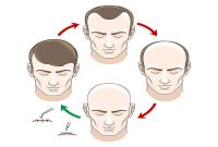 Follicular Unit Extraction (FUE) Hair Transplant