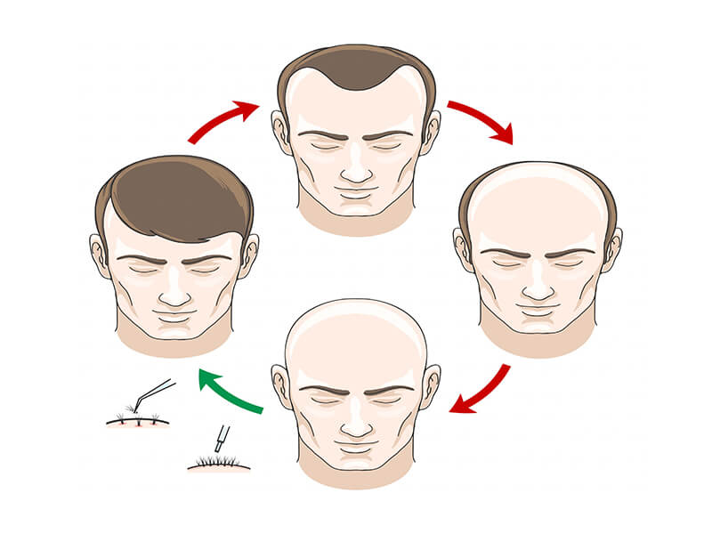 Follicular Unit Extraction (FUE) Hair Transplant