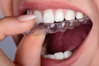 What is Unique About Invisalign?