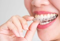 Crafting Smiles Through The Innovative Technology Of Invisalign