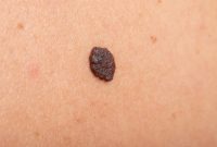 The Comprehensive Guide to Safe Mole Removal