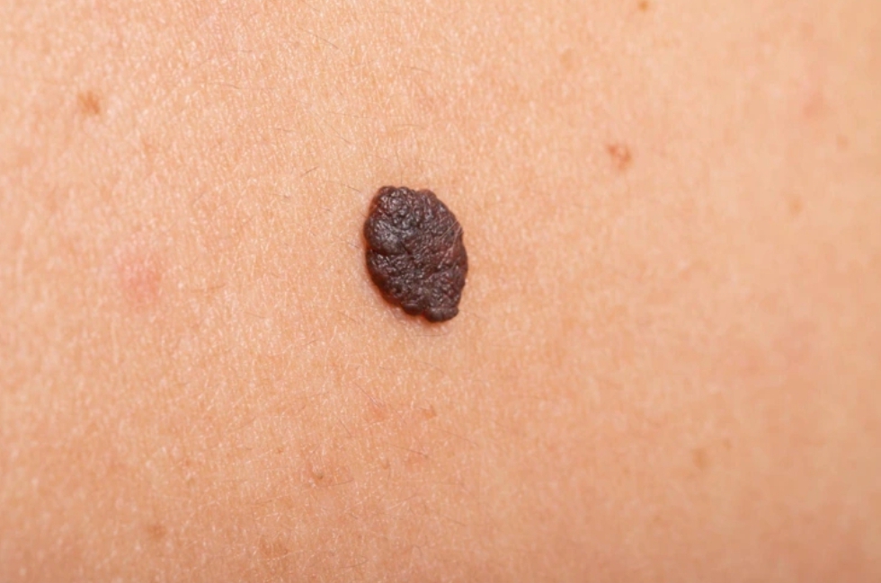 The Comprehensive Guide to Safe Mole Removal