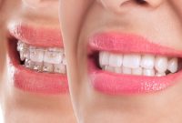 Post-Braces Care: Maintaining Your Newly Straightened Smile