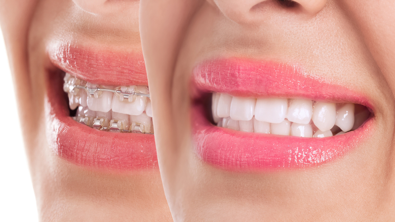 Post-Braces Care: Maintaining Your Newly Straightened Smile