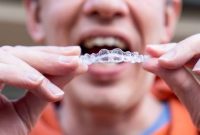 Benefits of Invisalign over Traditional Braces