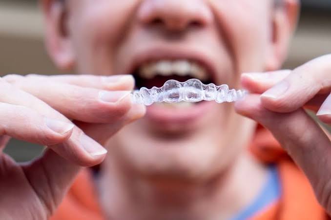 Benefits of Invisalign over Traditional Braces