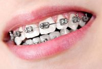 How Braces Enhance Long-Term Self-Confidence