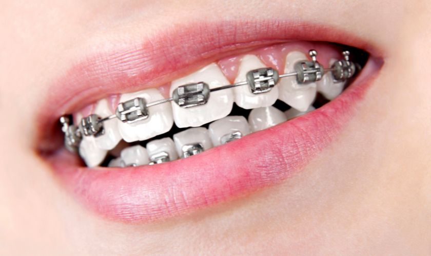 How Braces Enhance Long-Term Self-Confidence