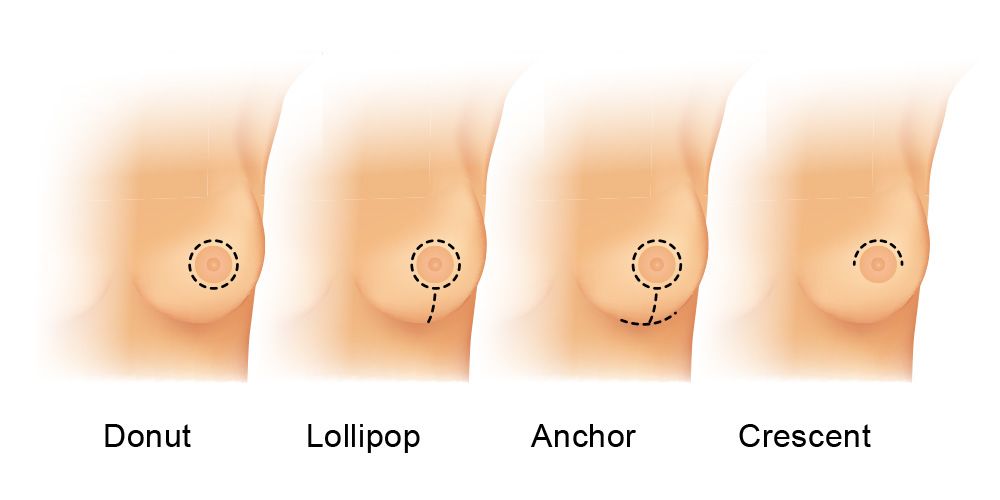 How is Breast Lift Done with Minimal Scarring